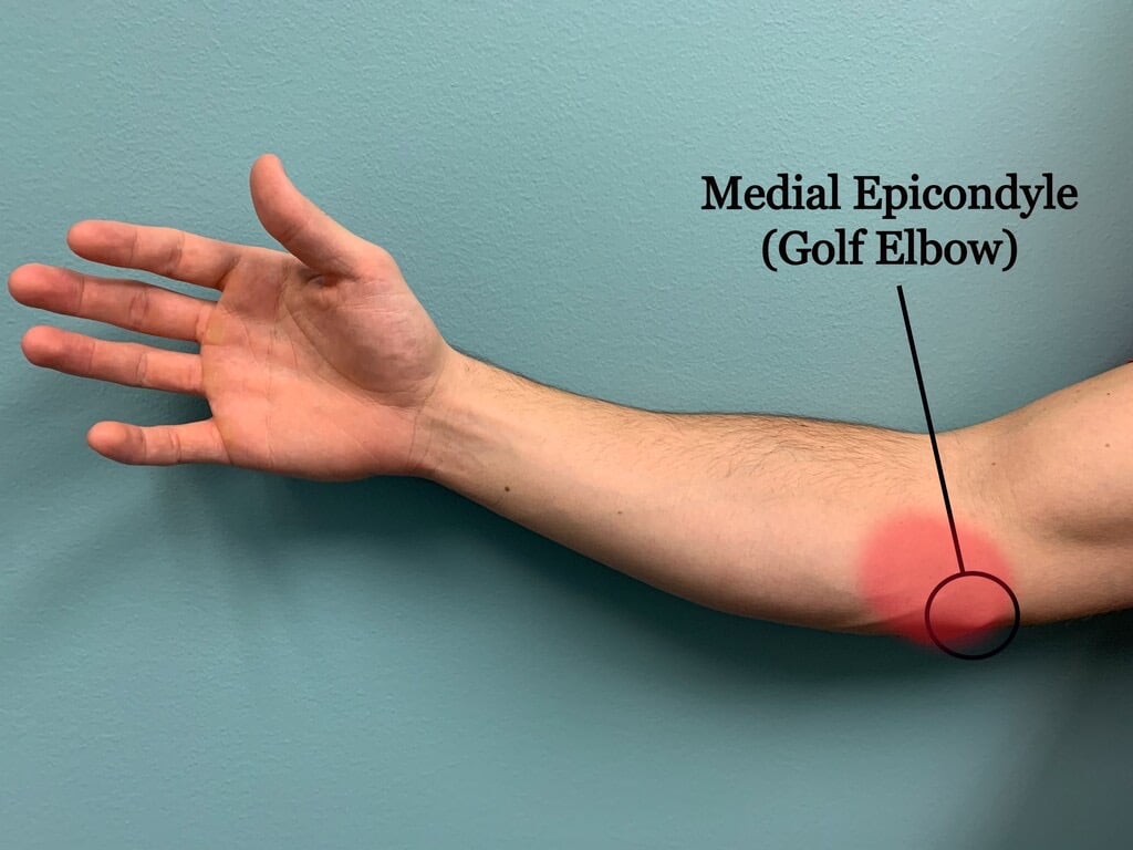 medial epicondylitis 