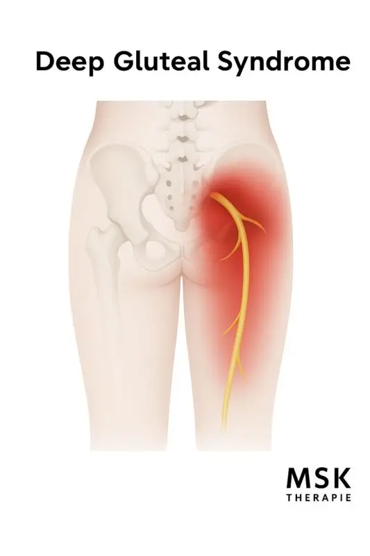 Medical illustration showing the front view of a human pelvis and upper thigh, highlighting the sciatic nerve in yellow and a red area indicating pain and inflammation in the deep gluteal region, labeled “Deep Gluteal Syndrome.” The logo “MSK Therapie” is displayed in the bottom right corner.